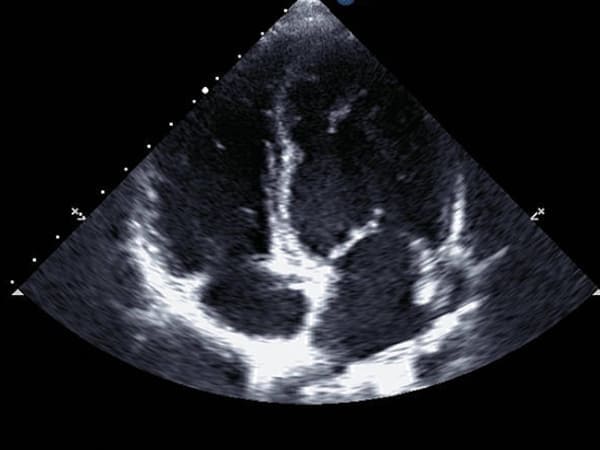 Ecocardiograma de estrés precio