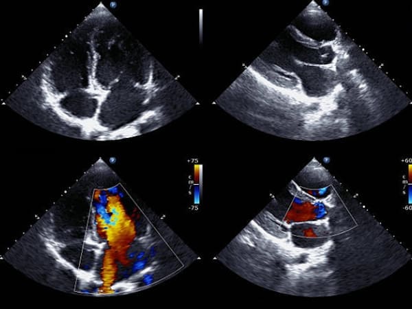 Ecocardiograma precio